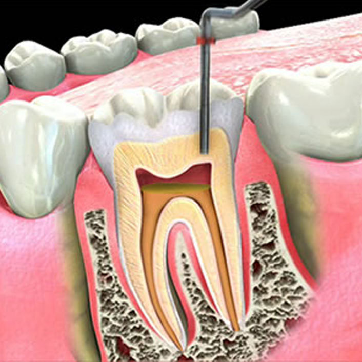 Dental Cleaning